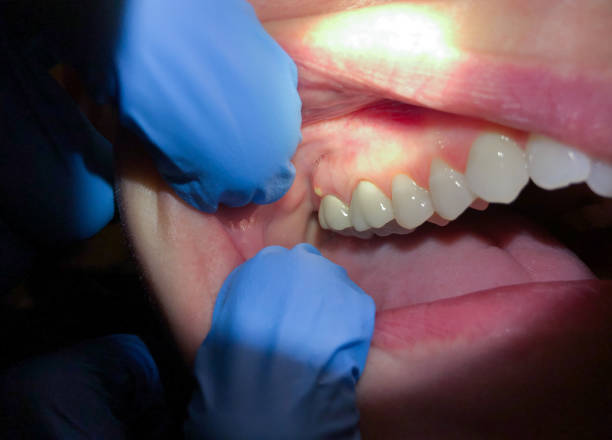 Best Emergency Dental Care for Broken or Chipped Teeth in Alameda, CA